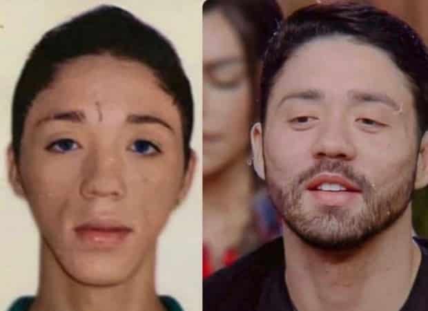 Rico Melquiades antes e depois das cirurgias