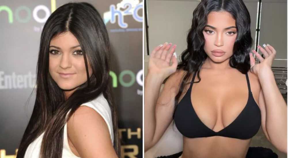 Kylie Jenner antes e depois