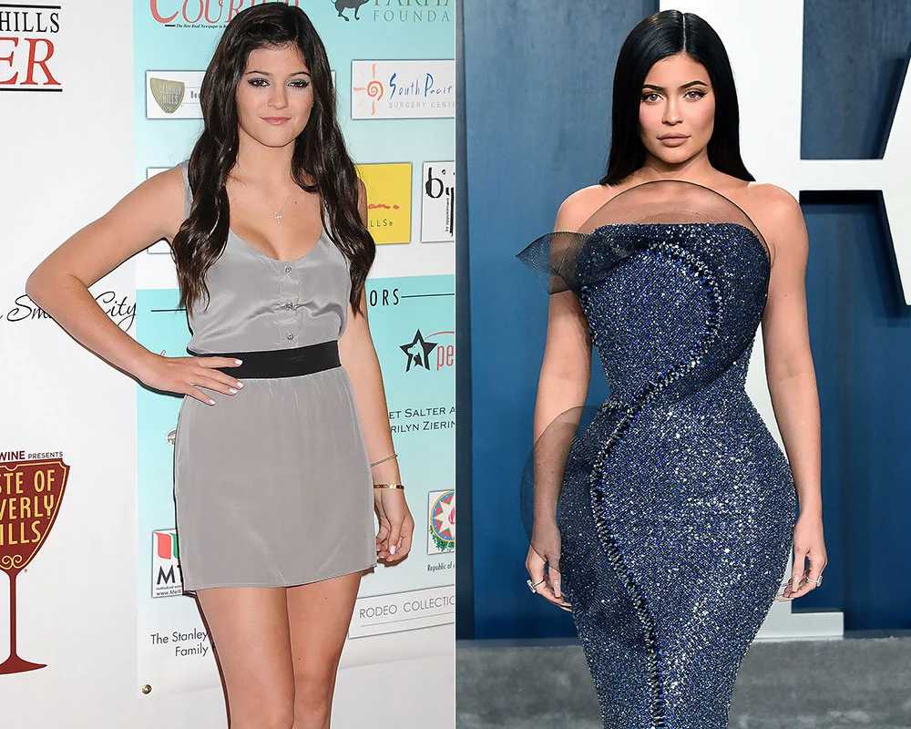 Kylie Jenner antes e depois