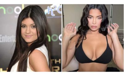 Kylie Jenner: antes e depois