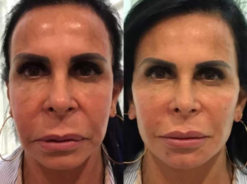 Gretchen Miranda antes e depois de harmonização facial