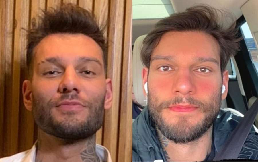 antes e depois de harmonização facial